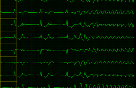 ekg